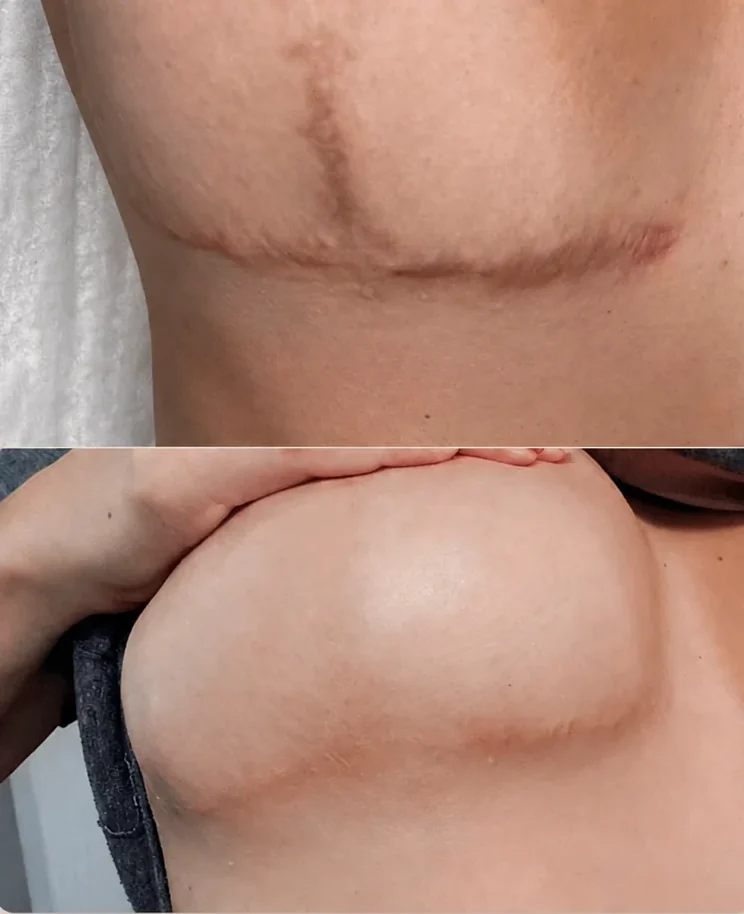 Chest scar camouflage, before and after